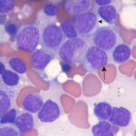 Acute Myeloid Leukemia with Myelodysplasia-Related Changes