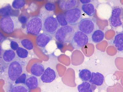 Acute Myeloid Leukemia with Myelodysplasia-Related Changes