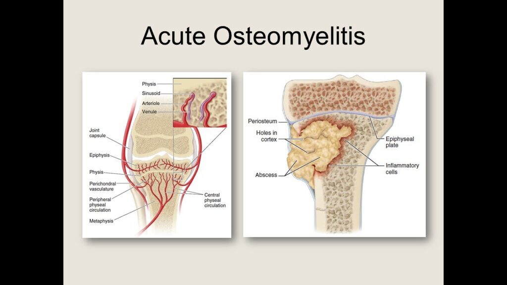 Acute osteomyelitis