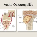 Acute osteomyelitis