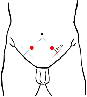 Acute Postoperative Pain Following Open Inguinal Hernia Repair