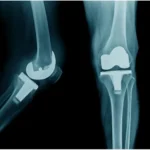 Acute Postoperative Pain Following Total Knee Arthroplasty