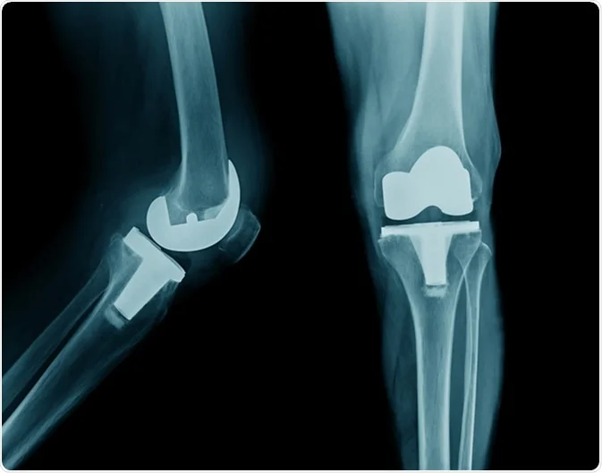 Acute Postoperative Pain Following Total Knee Arthroplasty