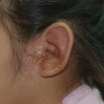 Acute Proteus mirabilis Otitis Externa