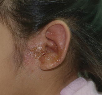 Acute Proteus mirabilis Otitis Externa