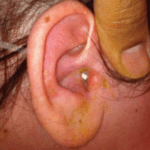 Acute Pseudomonas Aeruginosa Otitis Externa