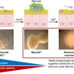 Acute Pseudomonas Aeruginosa Pneumonia Associated With Cystic Fibrosis