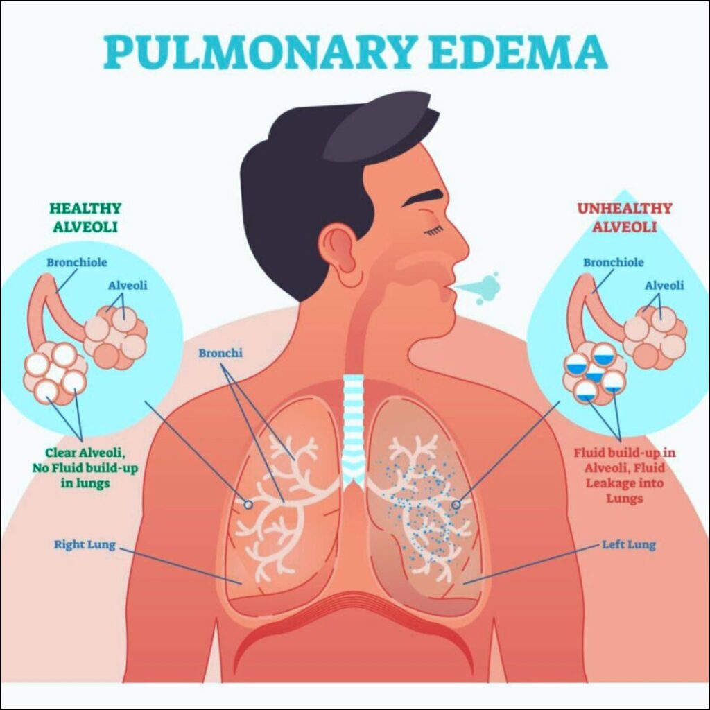 Acute Pulmonary Edema