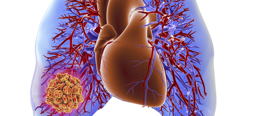 Acute Pulmonary Thromboembolism