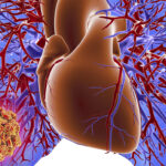 Acute Pulmonary Thromboembolism