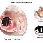 Acute Rheumatic Carditis