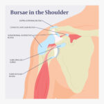 Acute Shoulder Pain Due To Bursitis