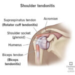 Acute Shoulder Pain Due To Tendonitis