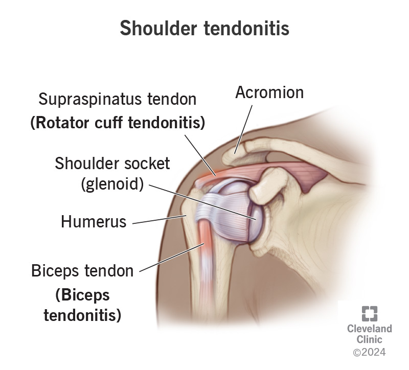 Acute Shoulder Pain Due To Tendonitis