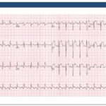 Acute St Elevation Myocardial Infarction