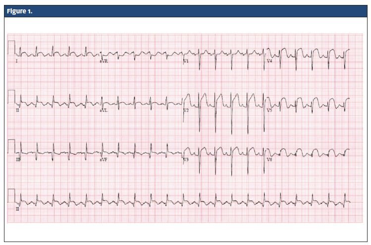 Acute St Elevation Myocardial Infarction