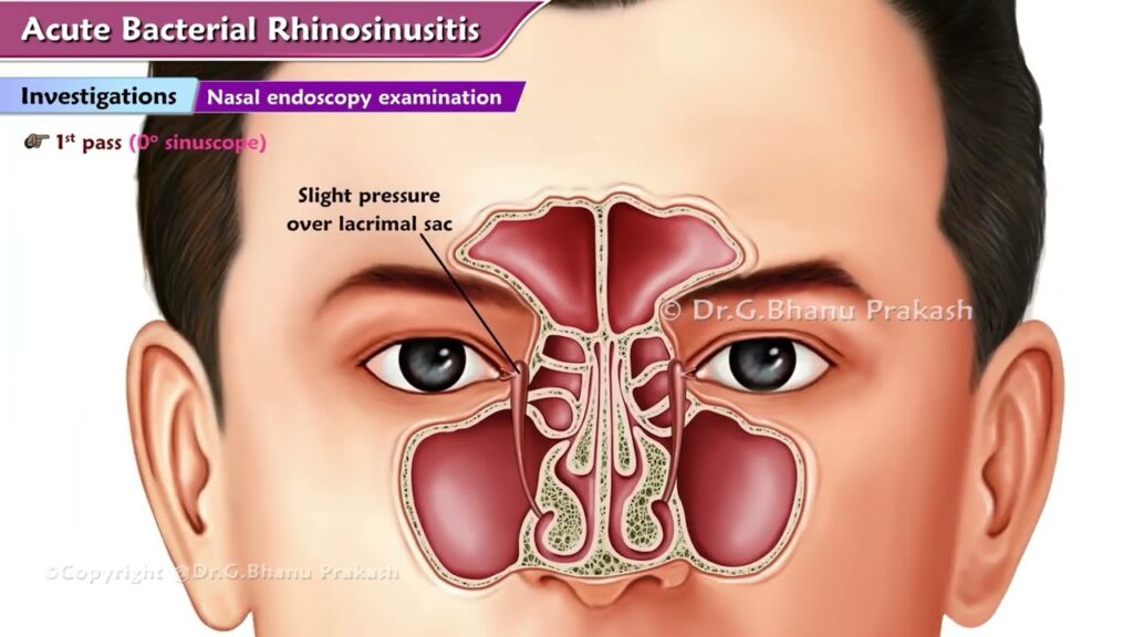 Acute Staph Aureus Sinusitis