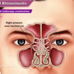 Acute Staph Aureus Sinusitis