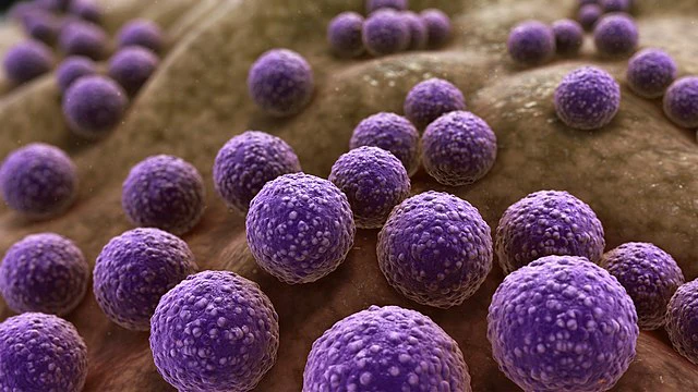 Acute Staphylococcal Bacterial Sinusitis