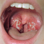 Acute Streptococcal Epiglottitis