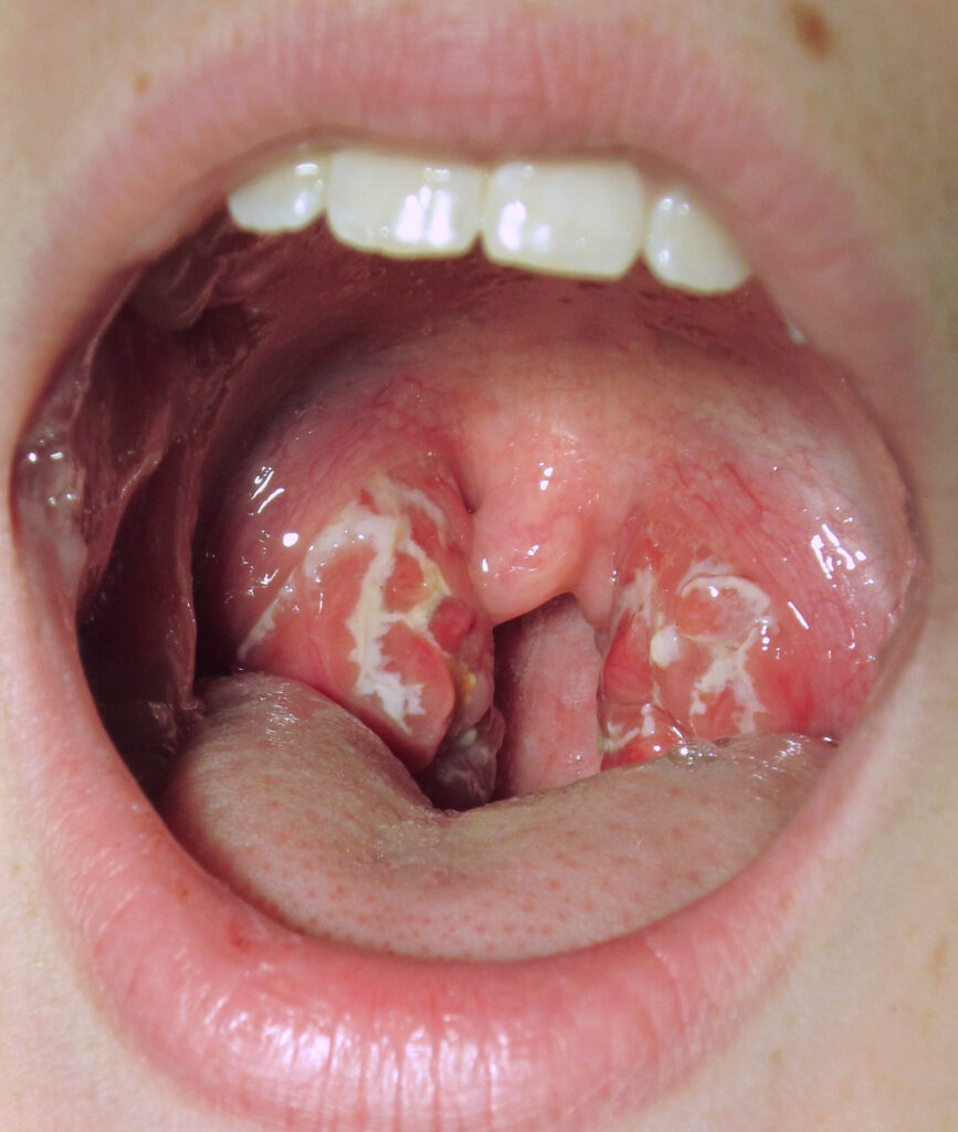 Acute Streptococcal Epiglottitis