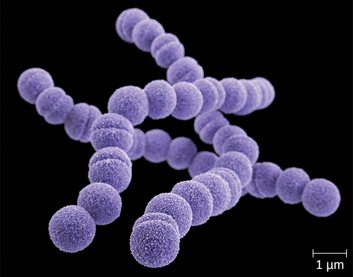 Acute Streptococcus Pyogenes Bacterial Sinusitis