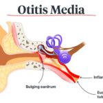 Acute Suppurative Otitis Media with Tympanostomy Tubes