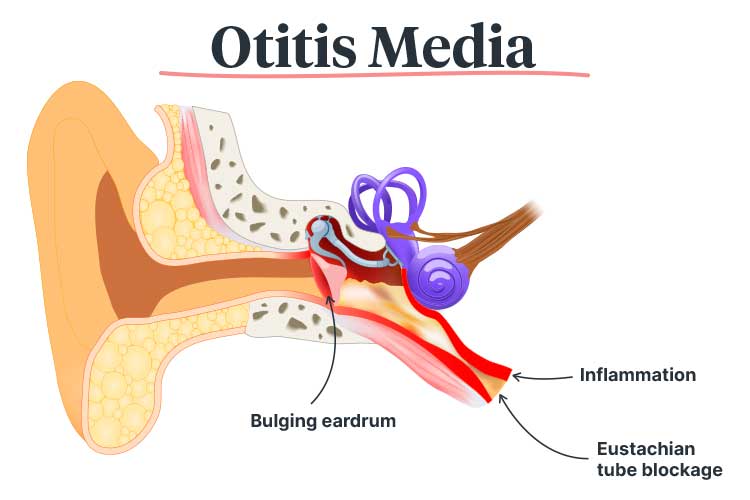 Acute Suppurative Otitis Media with Tympanostomy Tubes