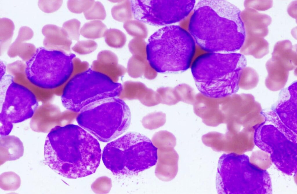 Acute promyelocytic leukemia