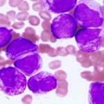 Acute promyelocytic leukemia