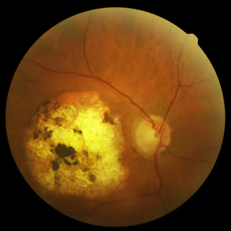 Congenital toxoplasmosis