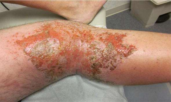 complicated skin and skin structure streptococcus pyogenes infection