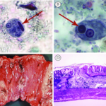 acute intestinal amebiasis caused by Entamoeba histolytica