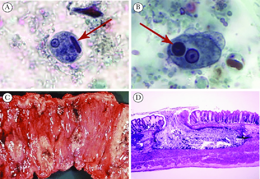 acute intestinal amebiasis caused by Entamoeba histolytica