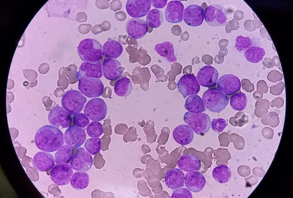 Acute Myeloid Leukemia