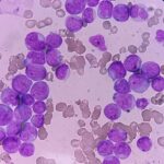 Acute Myeloid Leukemia