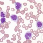 acute myelomonocytic leukemia