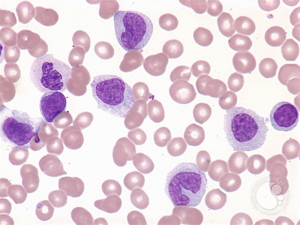 acute myelomonocytic leukemia