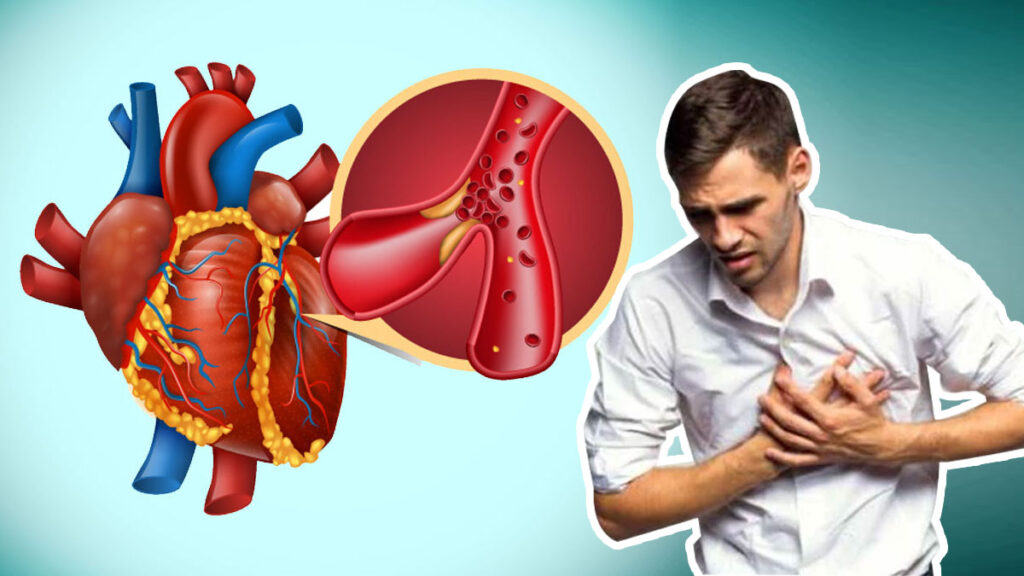 acute myocardial infarction