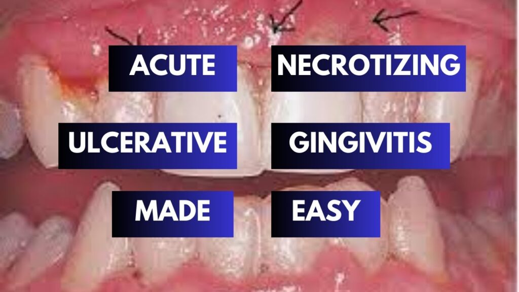 Acute Necrotizing Ulcerative Gingivitis