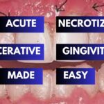 Acute Necrotizing Ulcerative Gingivitis