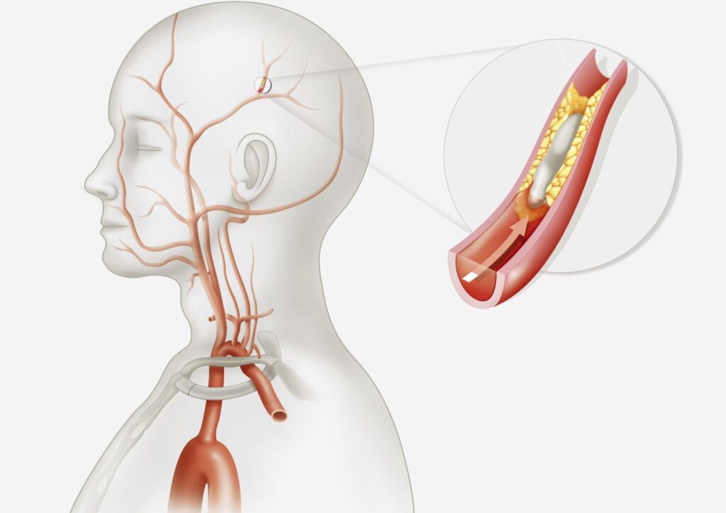 acute thromboembolic stroke