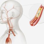 acute thromboembolic stroke