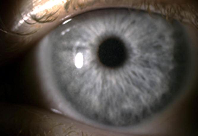 benign cystinosis with corneal cystine crystal accumulation