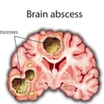 brain abscess