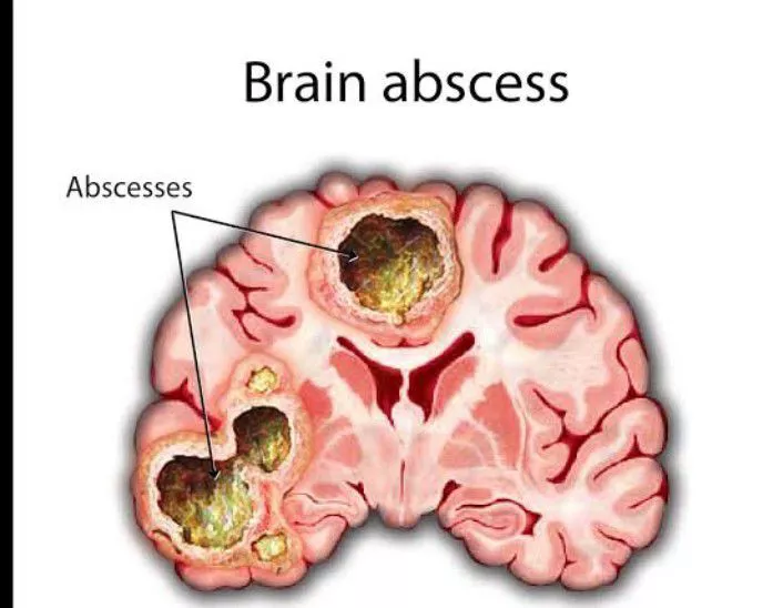 brain abscess