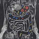 complicated streptococcus peritonitis