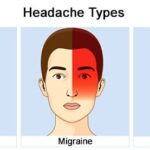 cluster headache prevention