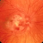 cmv retinitis in aids patient