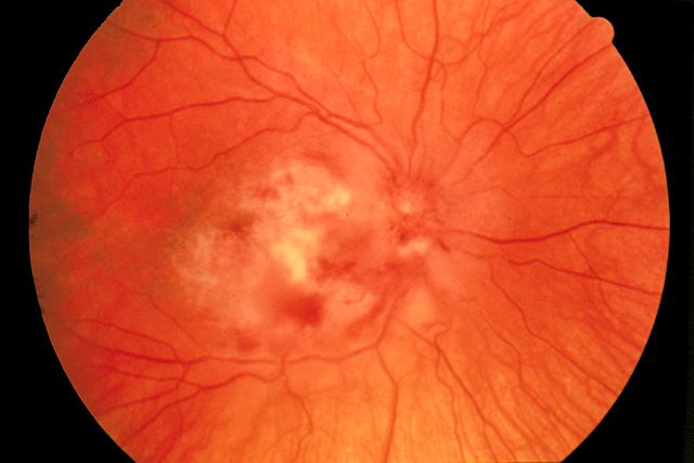 cmv retinitis in aids patient